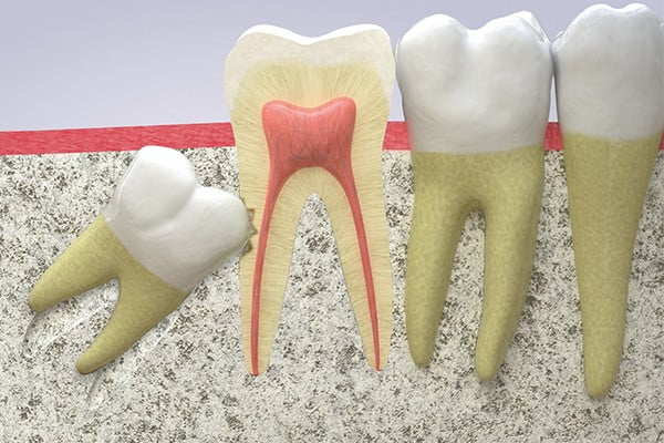 giải đáp nhổ răng khôn hàm dưới có nguy hiểm không?