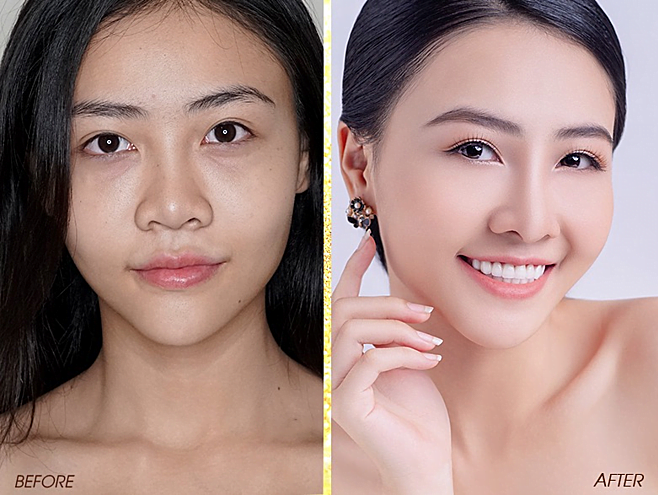 Hiệu quả dụng cụ nâng mũi