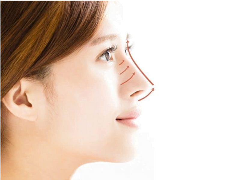 Nâng mũi bằng chỉ, nâng mũi chỉ