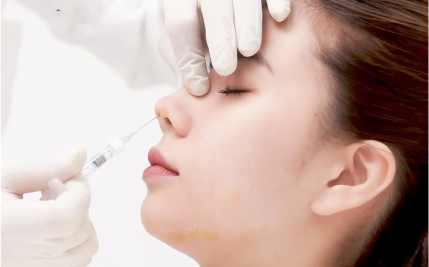 Nâng mũi bằng chỉ, nâng mũi chỉ