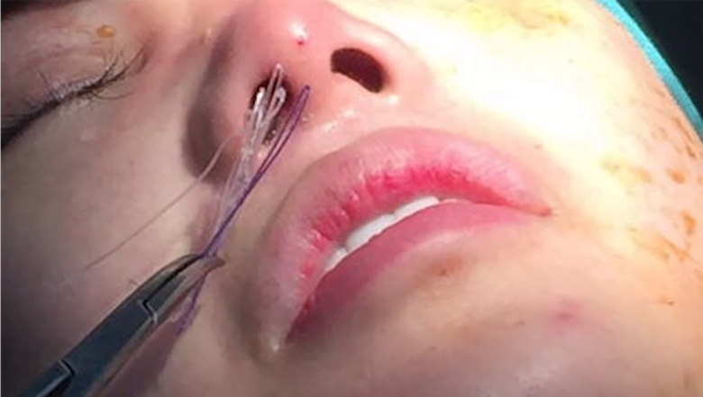 Nâng mũi bằng chỉ, nâng mũi chỉ