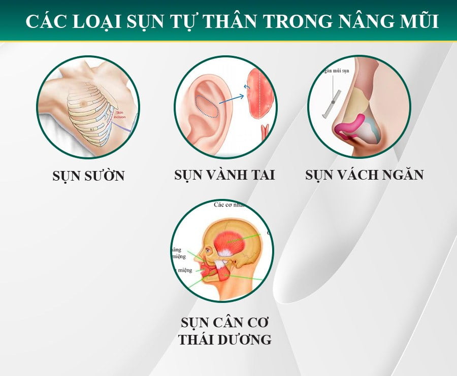 Nâng mũi, sửa mũi, sửa mũi hỏng-7
