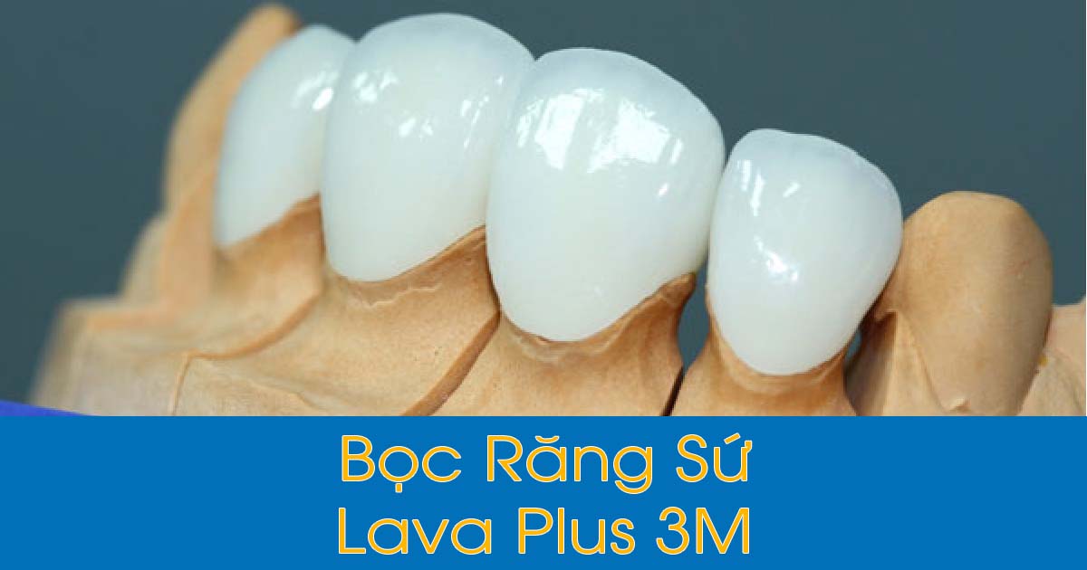 Bọc răng sứ Lava Plus 3M