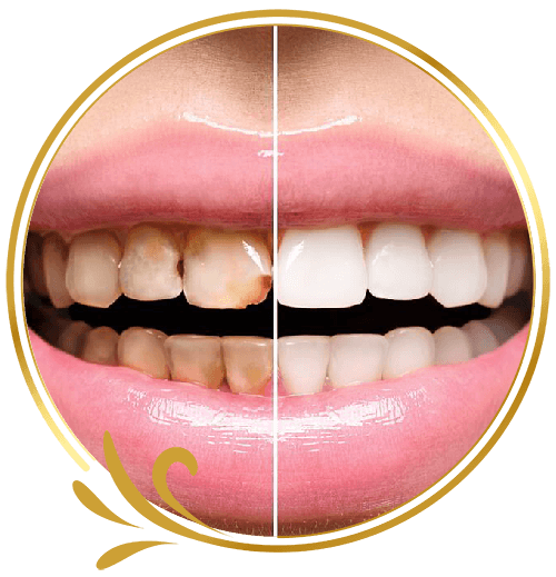 Bọc Răng Sứ Thẩm Mỹ