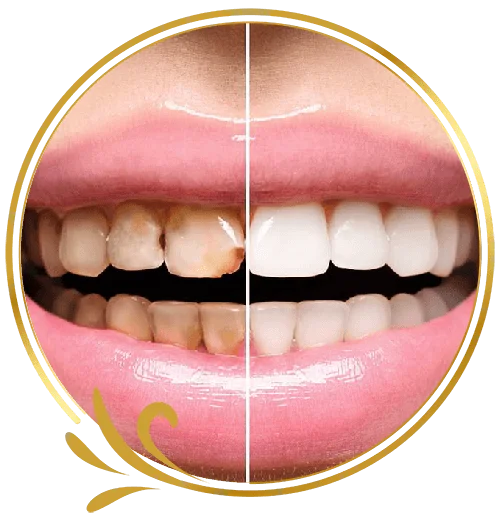 Bọc Răng Sứ Thẩm Mỹ