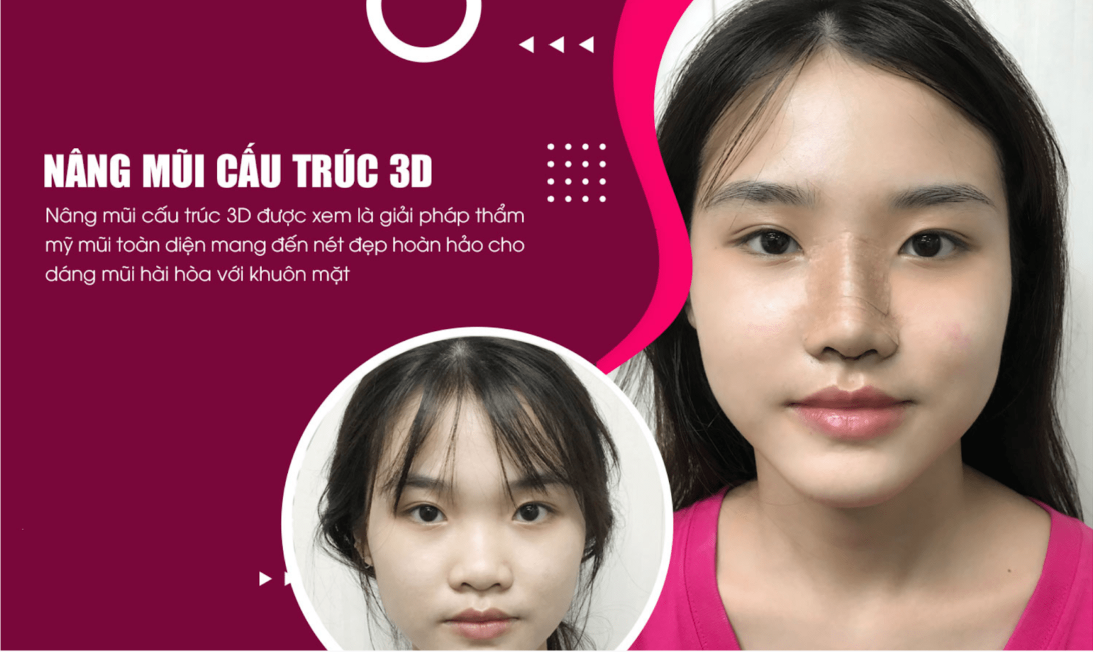 Top 10 địa chỉ nâng mũi tphcm tốt, uy tín, đẹp nhất