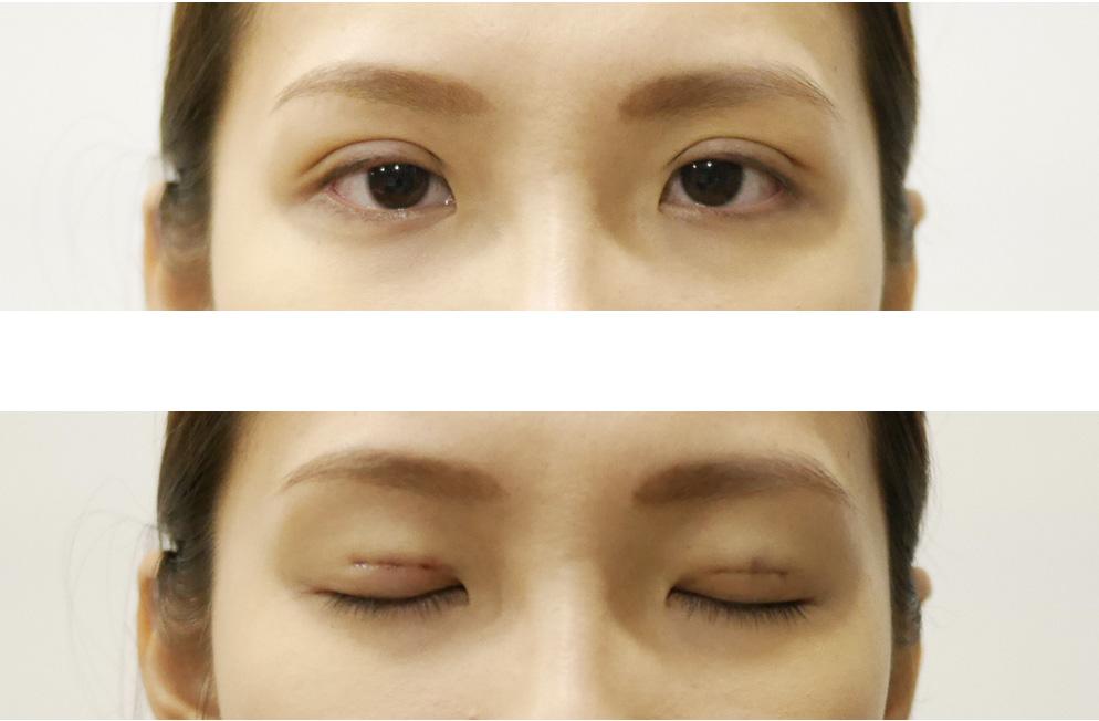 Nhấn mí độc đáo