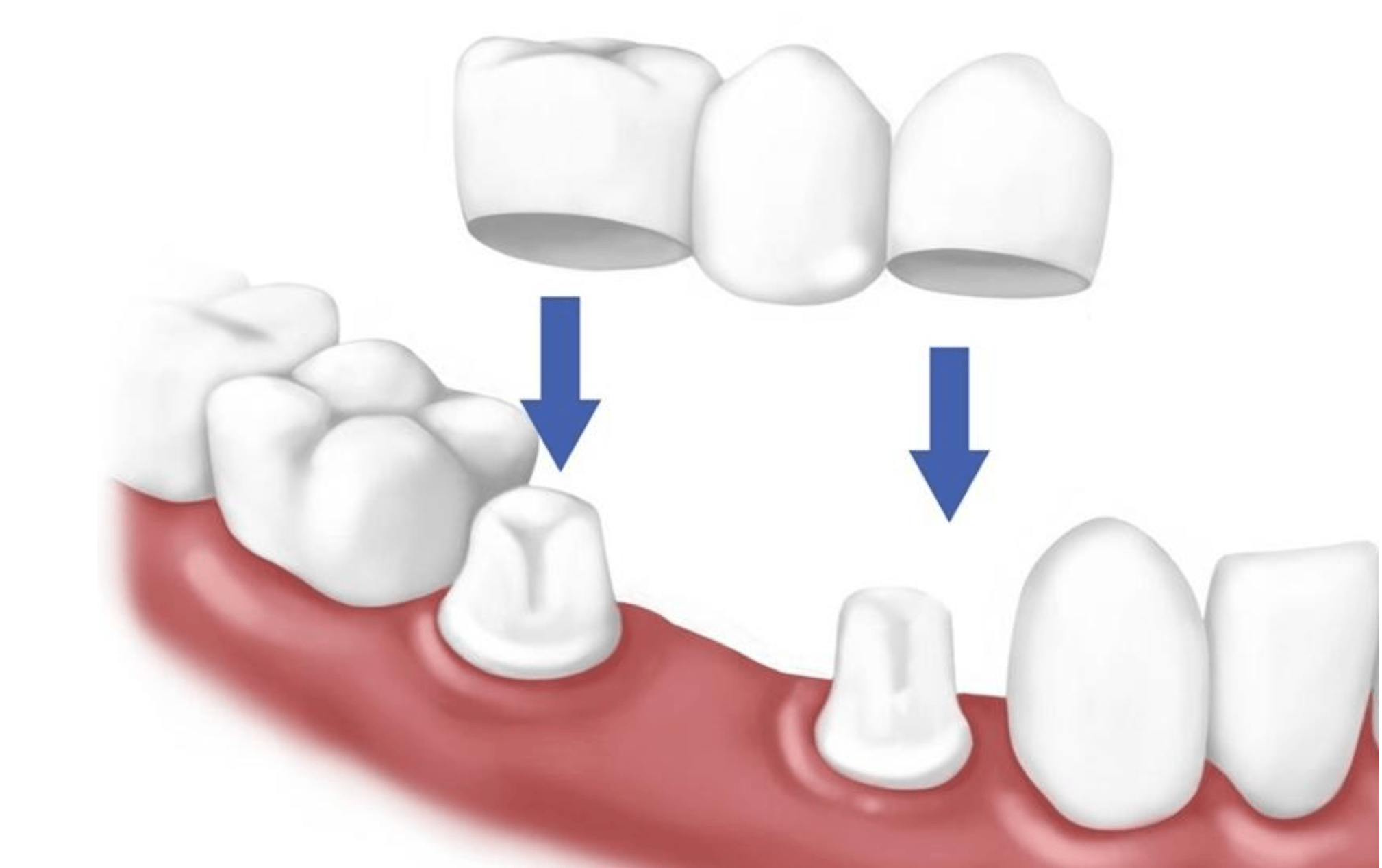 hậu quả bọc răng sứ giá rẻ