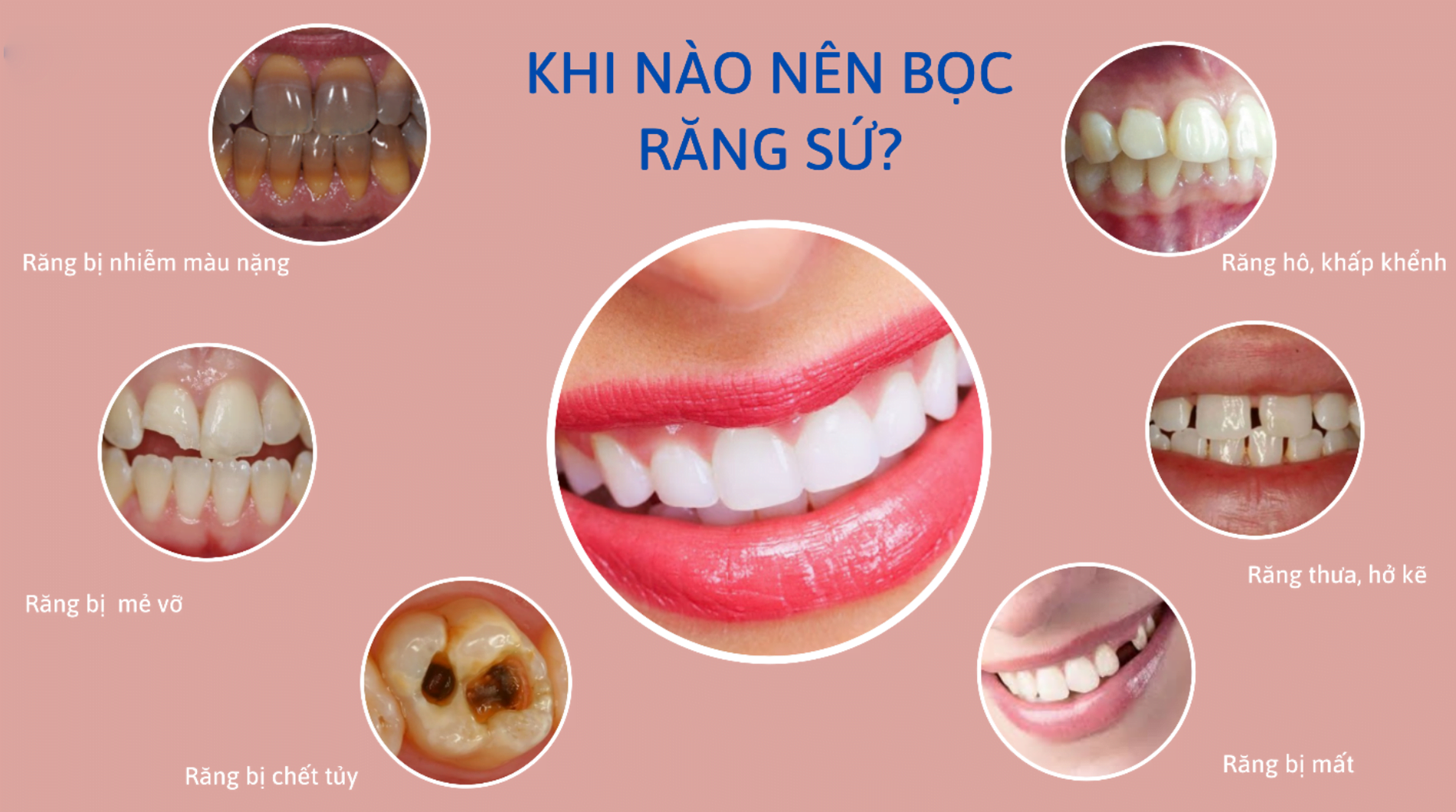 hậu quả bọc răng sứ giá rẻ