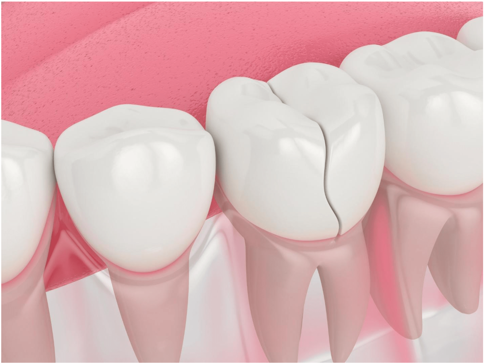 hậu quả bọc răng sứ giá rẻ