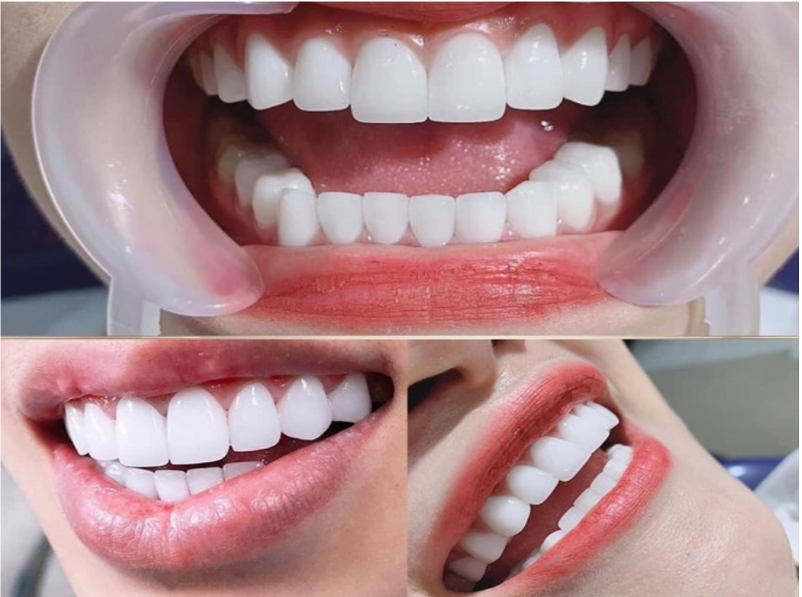 hậu quả bọc răng sứ giá rẻ