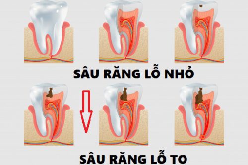 Trám Răng Sâu Lỗ Nhỏ Bao Nhiêu Tiền? - Cập Nhật Chi Phí Mới Nhất 2024