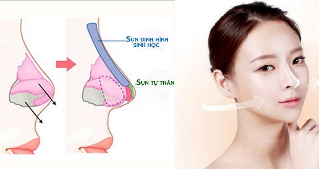 Nâng mũi, sửa mũi, sửa mũi hỏng-8