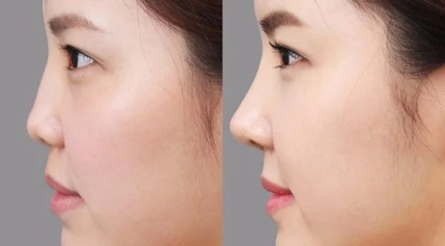 cách nâng mũi cấu trúc