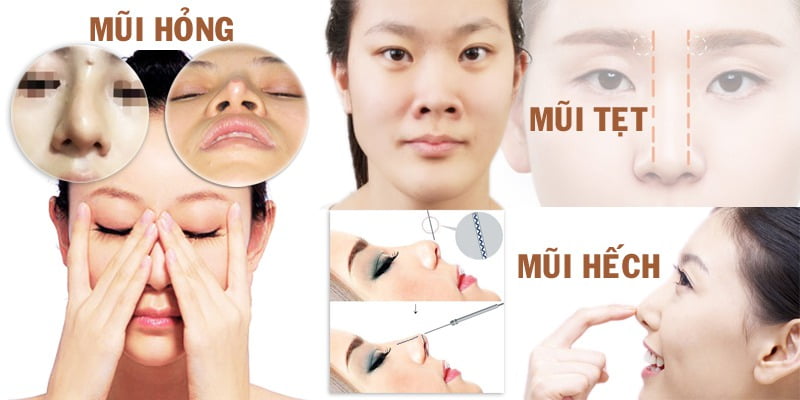Nâng mũi, sửa mũi, sửa mũi hỏng-2