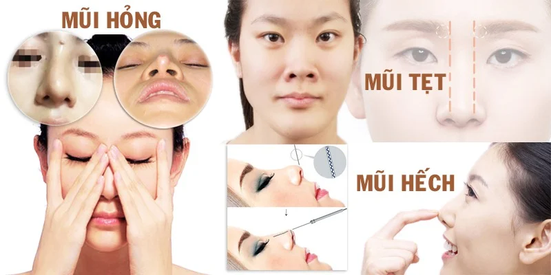 Nâng mũi, sửa mũi, sửa mũi hỏng-2