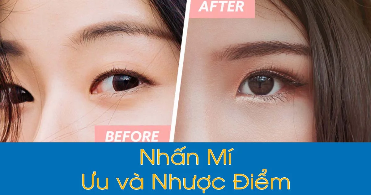 Nhân mí giá bao nhiêu