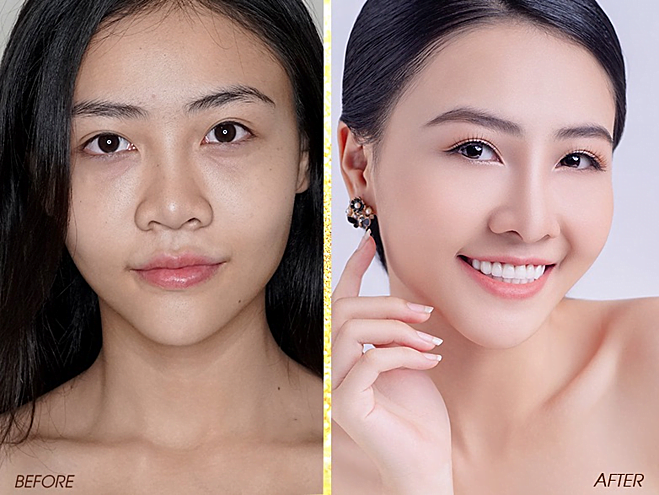 Nâng Mũi Bao Lâu Thì Đầu Mũi Hết To Và Đầu Mũi Mềm
