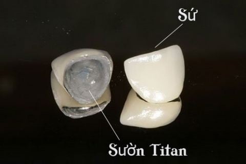 Răng sứ kim loại