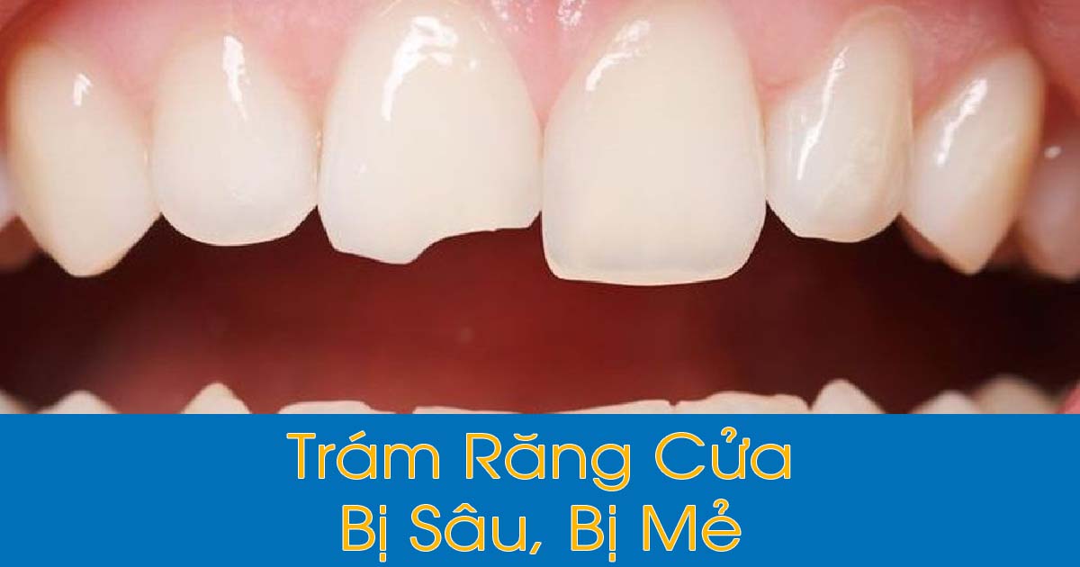 Trám răng cửa bao nhiêu tiền?