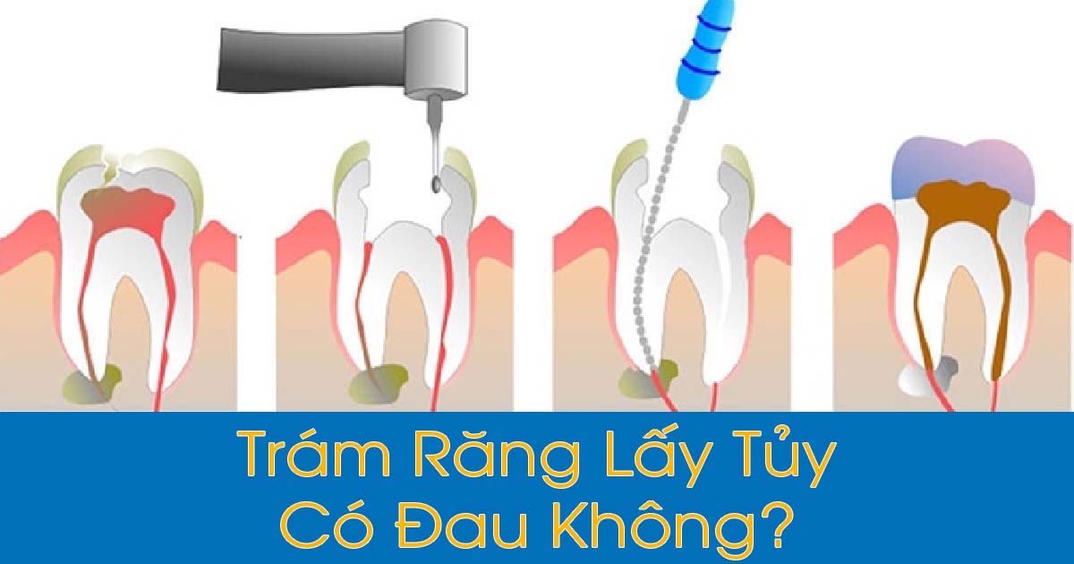 Trám răng lấy tủy có đau không?