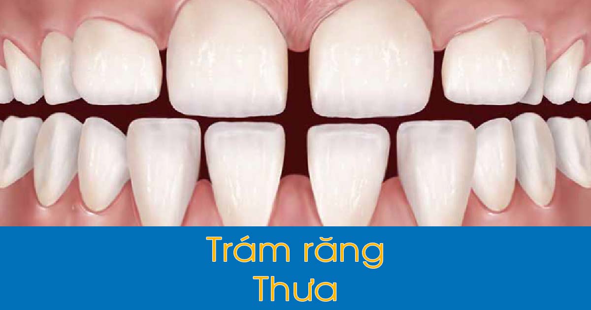 Trám răng thưa bao nhiêu tiền