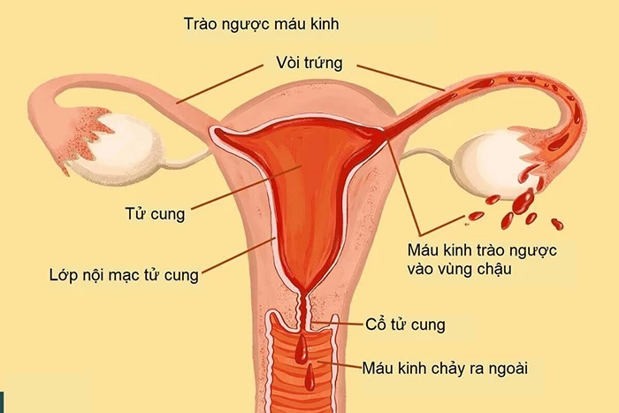 Lạc nội mạc tử cung là nguyên nhân khiến kinh nguyệt màu đen và đau bụng dữ dội.