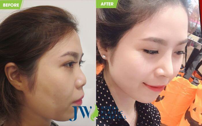 Nâng mũi giúp cải thiện diện mạo gương mặt thanh tú hơn