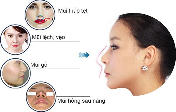 Các trường hợp mũi thường tìm đến thẩm mỹ nâng mũi