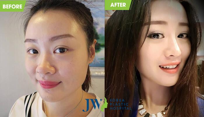 Nâng mũi giúp cải thiện diện mạo gương mặt thanh tú hơn