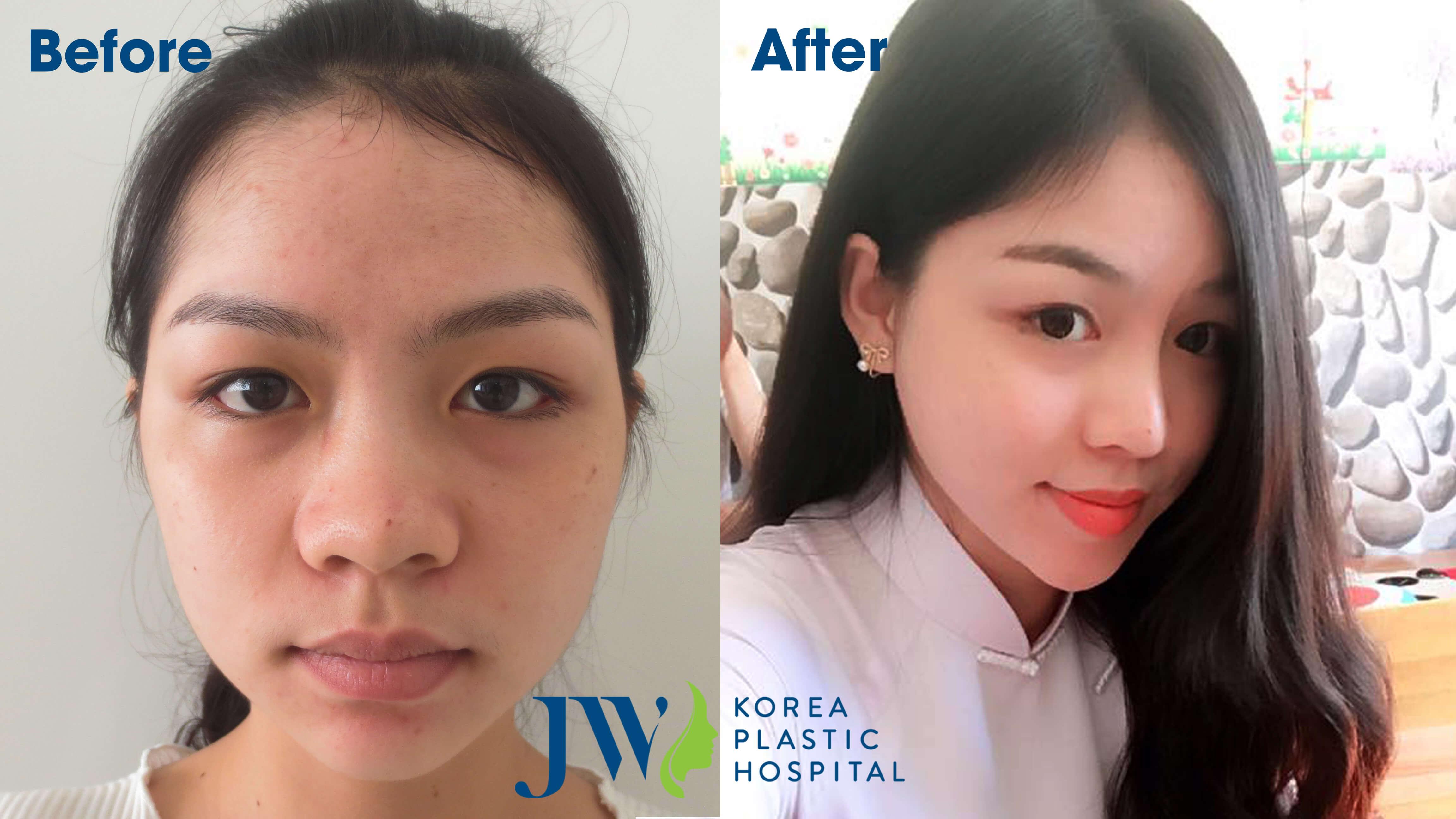 Nâng mũi giúp cải thiện diện mạo gương mặt thanh tú hơn