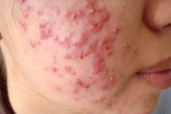 Mụn viêm đỏ không nhân và những điều bạn cần biết