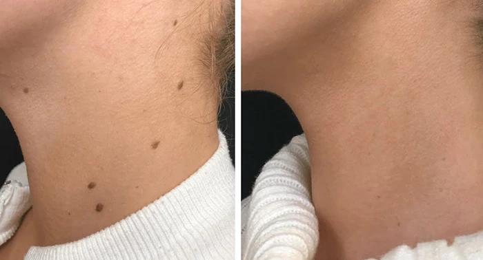 Trước và sau khi tẩy nốt ruồi bằng tia laser