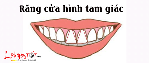 Tướng răng cửa hình tam giác