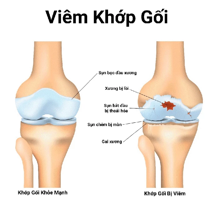 Sụn khớp bị bào mòn, thô ráp dẫn đến khớp xương cọ xát